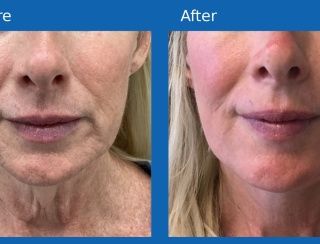 Facelift2