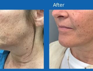 Facelift3