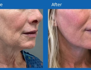 Facelift4