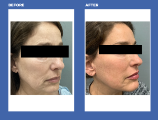 facelift