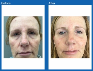 Brow-lift-fat-transfer