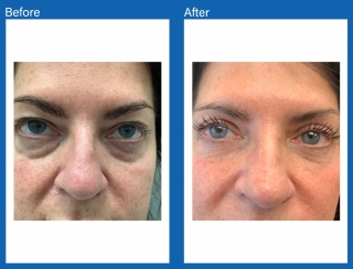 Eye-lid-surgery-fat-transfer