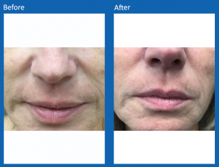 fat-transfer-face-1
