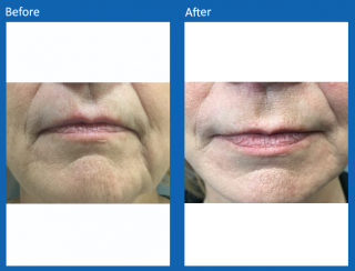 fat-transfer-face-5