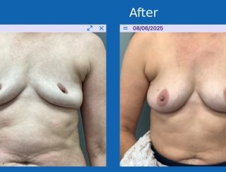 Fat-grafting-body