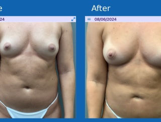 Fat-grafting-body1
