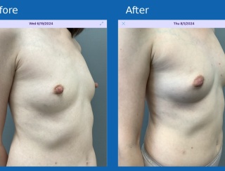 Fat-grafting-body2