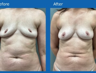 Fat-grafting-body3-4