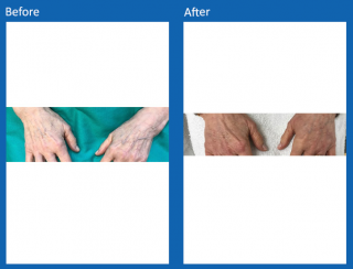 fat-grafting-2