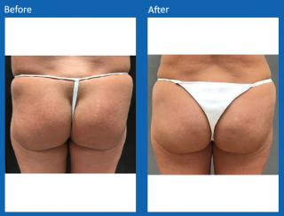 fat-grafting-3