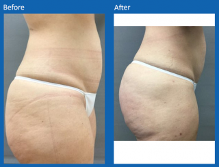 fat-grafting-4