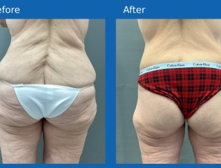 French-butt-lift