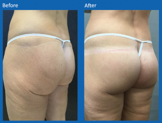 french-butt-lift-2
