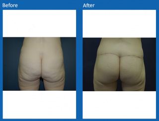 french-butt-lift-3