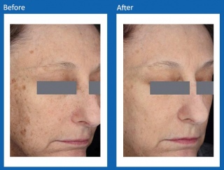 Frax-Before-and-After-1