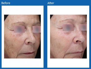 Frax-Before-and-After-2