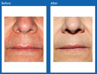 Frax-Before-and-After-3