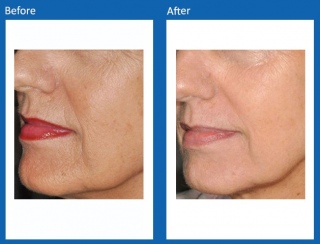 Frax-Before-and-After-4