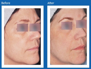 Frax-Before-and-After-5