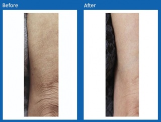 Frax-Before-and-After-6
