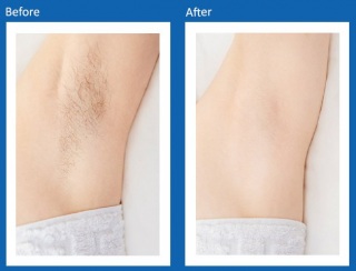 Hair-Removal-Before-and-After-1