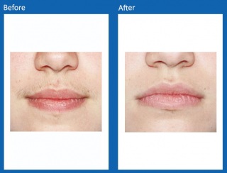 Hair-Removal-Before-and-After-2