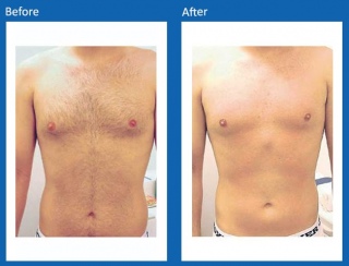 Hair-Removal-Before-and-After-3