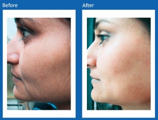 Hair-Removal-Before-and-After-4