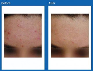 IPL-Before-and-After-1