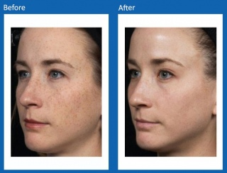 IPL-Before-and-After-2