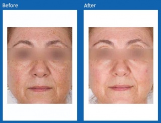 IPL-Before-and-After-3