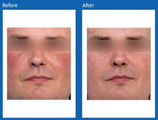 IPL-Before-and-After-4