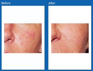 Lesions-Before-and-After-1