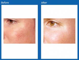 Lesions-Before-and-After-2