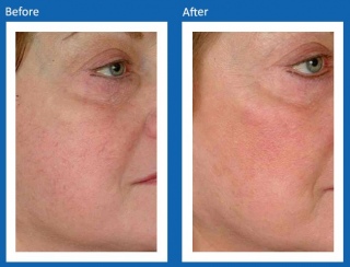 Lesions-Before-and-After-3
