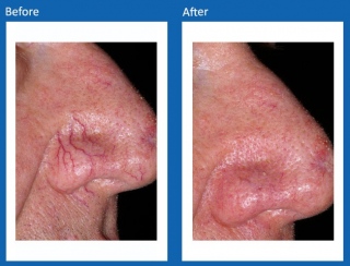 Lesions-Before-and-After-5