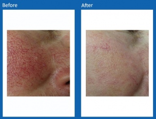 Lesions-Before-and-After-6