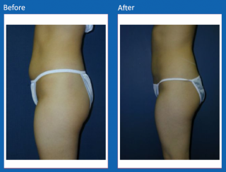 liposuction-1
