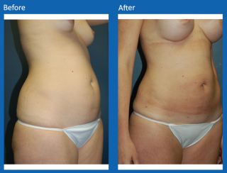 liposuction-10