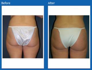 liposuction-11