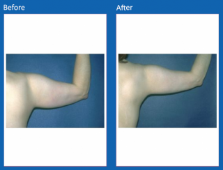 liposuction-12