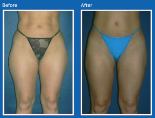 liposuction-13