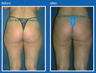 liposuction-14