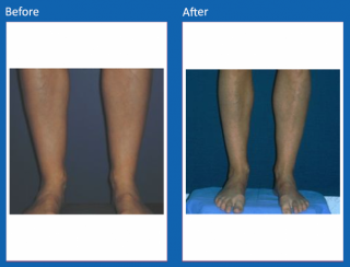 liposuction-15