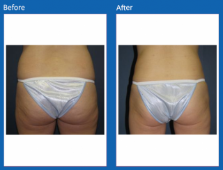 liposuction-16