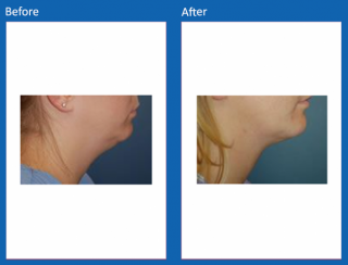 liposuction-17