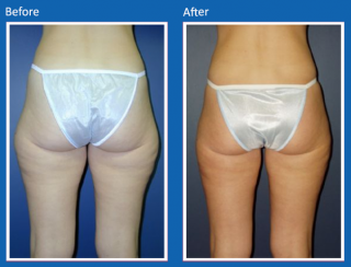 liposuction-18