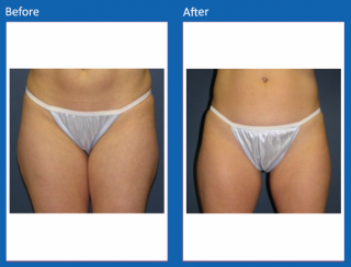 liposuction-19