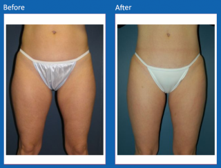 liposuction-2