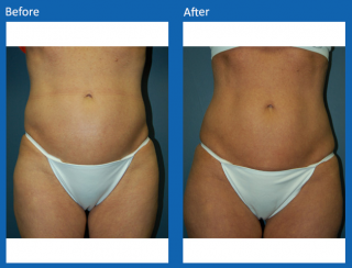 liposuction-21